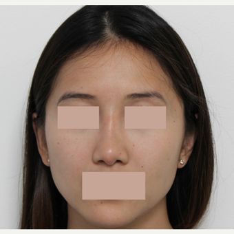 25-34 year old woman treated with Rhinoplasty after 3366531