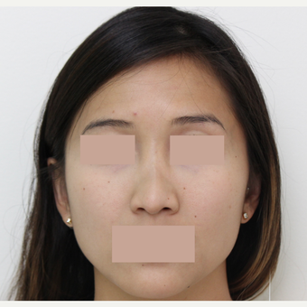25-34 year old woman treated with Rhinoplasty before 3366531