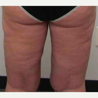 Inner Thigh Liposuction for this 42 Year Old Woman after 3181998