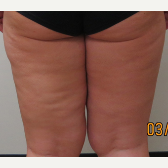 Inner Thigh Liposuction for this 42 Year Old Woman before 3181998