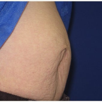 25-34 year old woman treated with Belly Button Surgery after 2659806