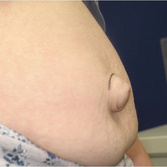 25-34 year old woman treated with Belly Button Surgery before 2659806