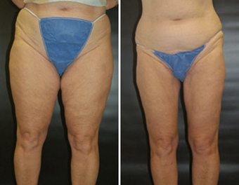 Thigh Lift before 1149470
