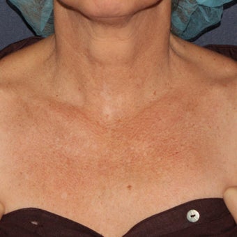 58 year old woman treated with IPL one time on the neck and chest before 1588230