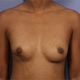 25-34 year old woman treated with Breast Augmentation before 3226372