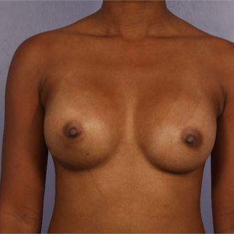 25-34 year old woman treated with Breast Augmentation after 3226372