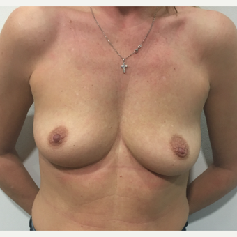 Breast augmentation before 3005033
