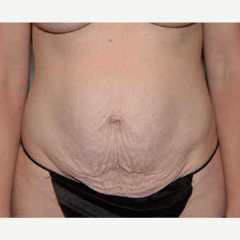 35 year old woman treated with Tummy Tuck before 3413997