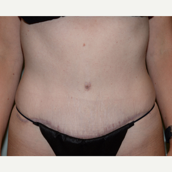 35 year old woman treated with Tummy Tuck after 3413997