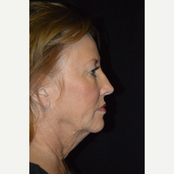 65-74 year old woman treated with Facelift before 3488162