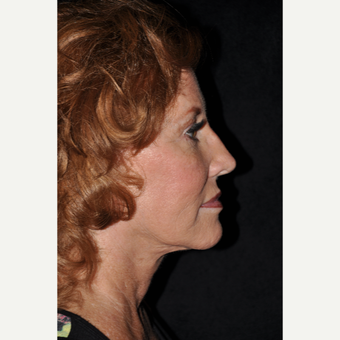 65-74 year old woman treated with Facelift after 3488162