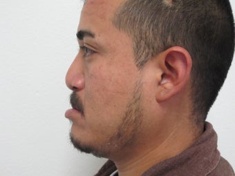 Secondary Cleft Lip and Cleft Rhinoplasty Revision 904077