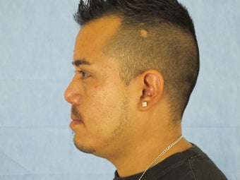 Secondary Cleft Lip and Cleft Rhinoplasty Revision 904077