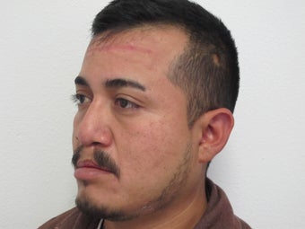 Secondary Cleft Lip and Cleft Rhinoplasty Revision before 904077