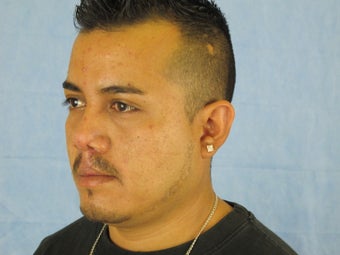 Secondary Cleft Lip and Cleft Rhinoplasty Revision after 904077