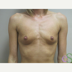 Breast Implants before 3373659