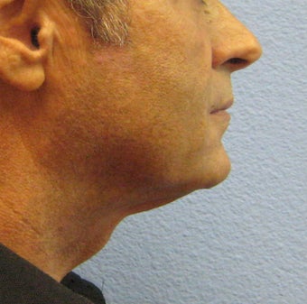 Ultherapy 1092018
