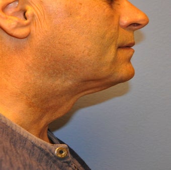 Ultherapy 1092018