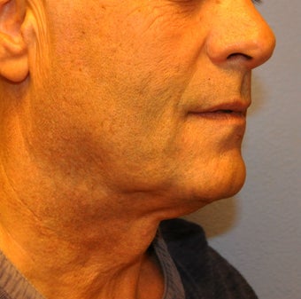 Ultherapy before 1092018