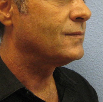 Ultherapy after 1092018