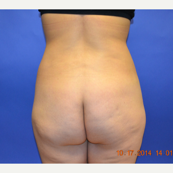 35-44 year old woman treated with Brazilian Butt Lift before 3170214