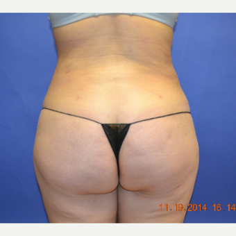 35-44 year old woman treated with Brazilian Butt Lift after 3170214
