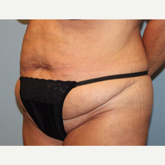 45-54 year old woman treated with Tummy Tuck before 3803275