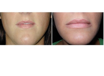 Lip Augmentation before 1254698