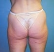 51 year old female patient before 926960