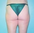 51 year old female patient after 926960