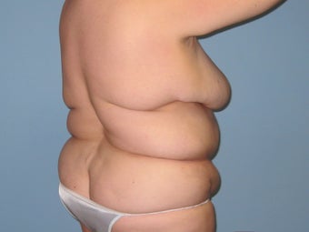Patient treated for Vaser Lipo of the back 1048377