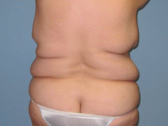 Patient treated for Vaser Lipo of the back before 1048377