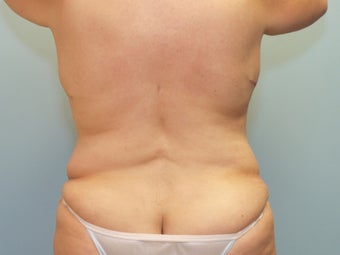Patient treated for Vaser Lipo of the back after 1048377