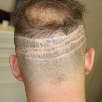 40 year old man treated with FUE Hair Transplant before 3615202