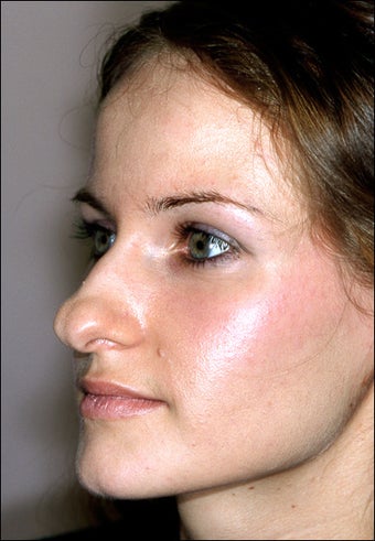 Rhinoplasty before 951730