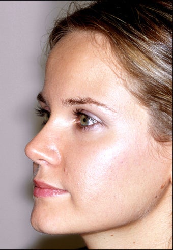 Rhinoplasty after 951730