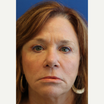 55-64 year old woman treated with Laser Resurfacing after 3104416