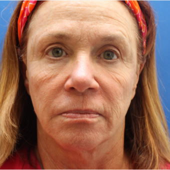 55-64 year old woman treated with Laser Resurfacing before 3104416