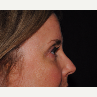 50 year old woman undergoes upper and lower blepharoplasty after 3439855