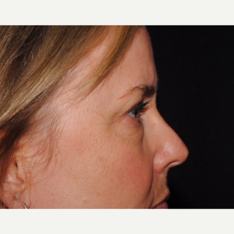 50 year old woman undergoes upper and lower blepharoplasty before 3439855