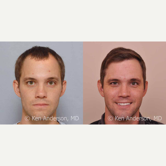 32yo man - ARTAS Robotic Hair Transplant surgery with PRP and ACell - 14 month post-op pics before 3009204