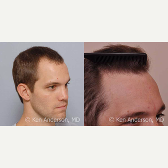 32yo man - ARTAS Robotic Hair Transplant surgery with PRP and ACell - 14 month post-op pics after 3009204