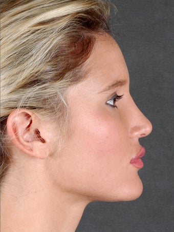Rhinoplasty after 970097
