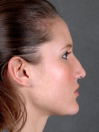 Rhinoplasty before 970097