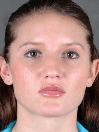 Rhinoplasty 970097