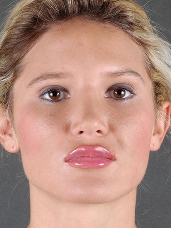 Rhinoplasty 970097