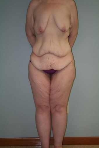 43 yr old lady. LBL, brachioplasty with J-component and liposuction legs before 1221932