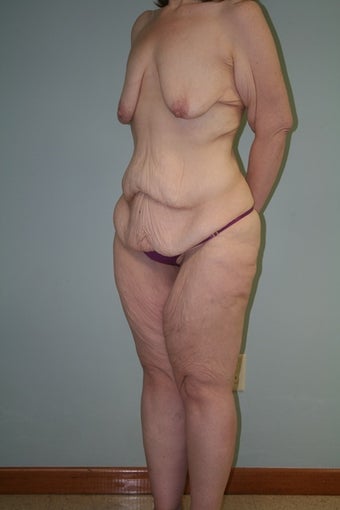 43 yr old lady. LBL, brachioplasty with J-component and liposuction legs 1221932