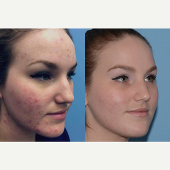 25-34 year old woman treated with Acne Treatment before 3246047
