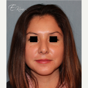 35-44 year old woman treated with Rhinoplasty before 3577982